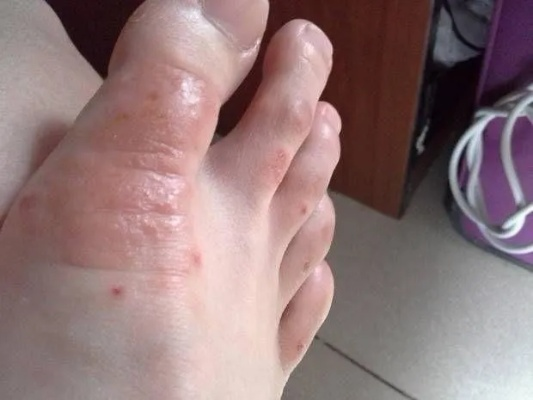 脚上起小水泡还很痒是怎么回事?一篇文章说清楚原因和应对方法 脚上起小水泡还很痒是怎么回事?一篇文章说清楚原因和应对方法